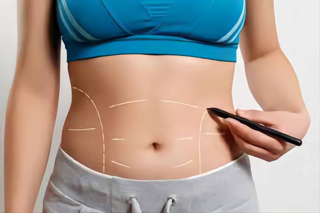 correct tummy tuck postpartum(1)